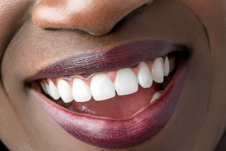 55469156-macro-close-up-of-african-female-mouth-showing-perfect-white-teeth