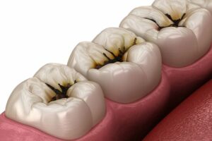 carie-maladie-parodontale-marseille