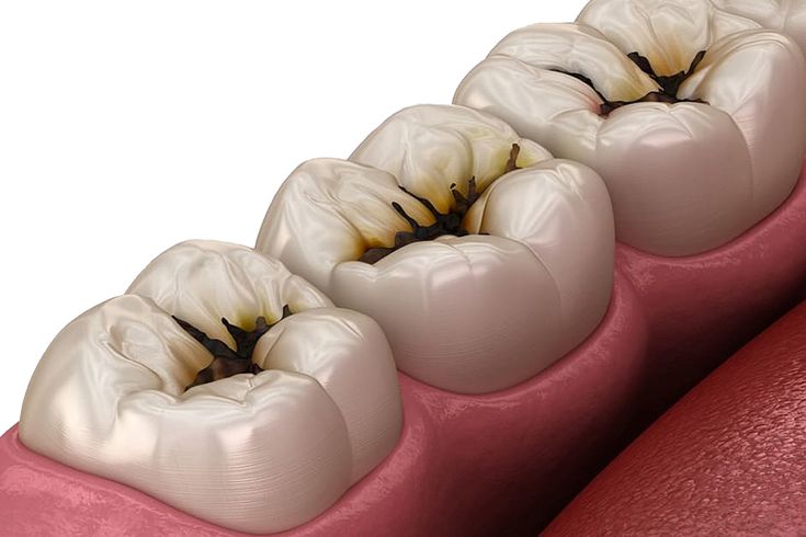 carie-maladie-parodontale-marseille